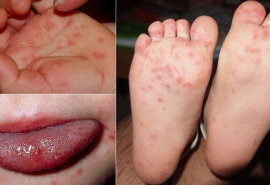 Bộ Y tế khuyến cáo trẻ mắc tay chân miệng phải cách ly 10 ngày