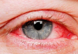TP HCM: Xác định tác nhân gây bệnh đau mắt đỏ trên địa bàn Thành phố
