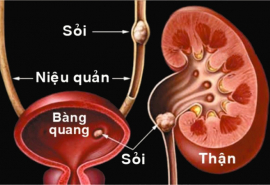 Cách phòng ngừa sỏi tiết niệu