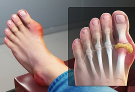 Bệnh gout có xu hướng trẻ hóa, bác sĩ chỉ cách phòng ngừa