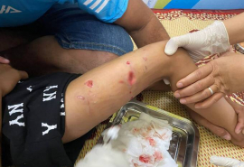 Thừa Thiên Huế: Tiếp nhận tiêm chủng bệnh nhi bị chó cắn với nhiều vết thương sâu