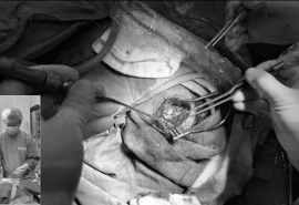 Đắk Lắk: Phẫu thuật loại bỏ khối u xương sọ trán hiếm gặp