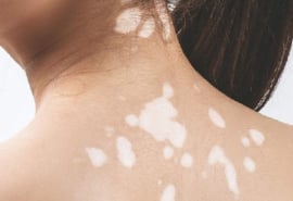 9 nguyên nhân gây đốm trắng trên da