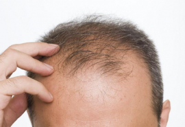 Tác động tích cực của HMPF Complex 2m trong việc giảm rụng tóc và kích thích tóc mọc mới