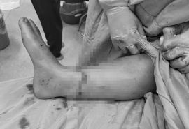 Đắk Lắk: Phẫu thuật nối liền bàn chân bị đứt rời cho bệnh nhân bị tai nạn giao thông