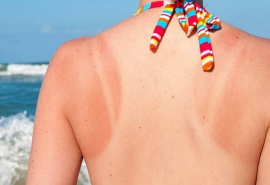 7 bệnh về da thường gặp trong mùa hè và cách phòng tránh