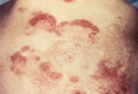 Triệu chứng bệnh nấm da, chân và móng