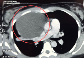 Cần Thơ: Nội soi lấy khối u trung thất khổng lồ chèn ép tim phổi cho người bệnh