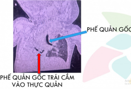 TP. HCM: Cứu sống bệnh nhi dị dạng bẩm sinh phế quản gốc bên phải xuất phát bất thường từ thực quản