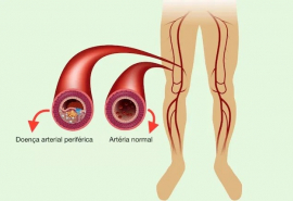 Triệu chứng, nguyên nhân và cách điều trị bệnh động mạch chủ ngoại biên