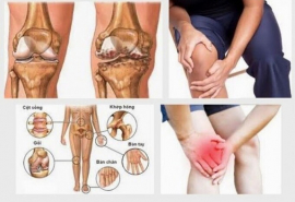 Bệnh thấp khớp vào mùa lạnh và cách phòng ngừa