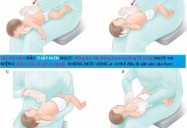 Hướng dẫn cách thực hiện thủ thuật Heimlich giúp cứu người bị hóc dị vật