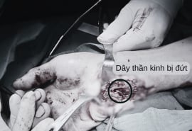 Tức giận, nam thanh niên đập tay vào kính, đứt gân cơ và bó mạch thần kinh cổ tay