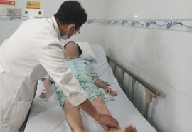 Suýt đoạn chi vì huyết khối tĩnh mạch chậu – đùi cấp