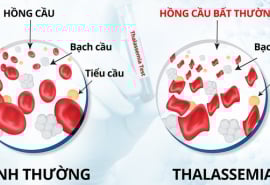 Hưởng ứng Ngày Thalassemia Thế giới 8/5: Chung tay vì sức khỏe cộng đồng