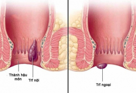 Hiểu đúng về bệnh trĩ để phòng ngừa hiệu quả