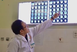 Bệnh viện Đa khoa Cà Mau can thiệp thành công ca phình mạch não