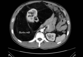 Phẫu thuật lấy trọn bướu mỡ khổng lồ nặng 8 kg trong bụng bệnh nhân