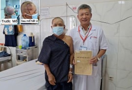Đắk Lắk: Phẫu thuật thành công khối u “khổng lồ” vùng đầu cho bệnh nhân 58 tuổi