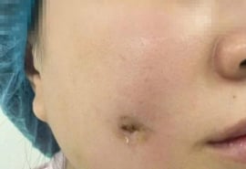 Cô gái bị nhiễm trùng sau khi đi làm má lúm đồng tiền