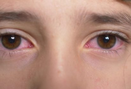 Bệnh đau mắt đỏ đang gia tăng, cần làm gì để phòng bệnh?