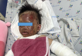 Cấp cứu bé gái 23 tháng tuổi bị bỏng nặng do bếp gas mini phát nổ