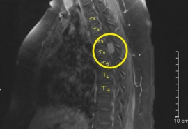 Bình Dương: Phẫu thuật thành công ca u màng tủy T3-T4, giúp bệnh nhân thoát khỏi cảnh liệt 2 chân