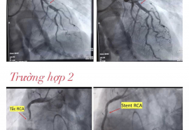 Bình Dương: Cứu sống hai bệnh nhân nguy kịch bằng kỹ thuật đặt stent