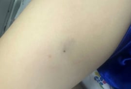 Cứu sống bé trai bị ong đốt gây sốc phản vệ