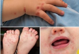 Vắc xin EV71 – Hy vọng mới trong phòng, chống bệnh tay chân miệng tại Việt Nam