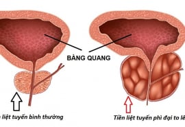 Bệnh phì đại tuyến tiền liệt: Có nên quan hệ tình dục?