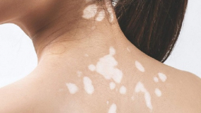9 nguyên nhân gây đốm trắng trên da