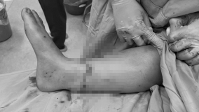Đắk Lắk: Phẫu thuật nối liền bàn chân bị đứt rời cho bệnh nhân bị tai nạn giao thông