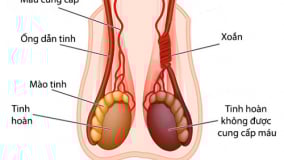 Cảnh giác với xoắn tinh hoàn ở trẻ em