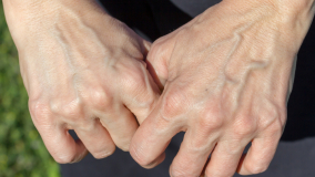 Nổi gân tay sau sinh: Nguyên nhân và cách chữa trị