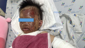 Cấp cứu bé gái 23 tháng tuổi bị bỏng nặng do bếp gas mini phát nổ