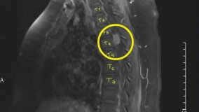 Bình Dương: Phẫu thuật thành công ca u màng tủy T3-T4, giúp bệnh nhân thoát khỏi cảnh liệt 2 chân