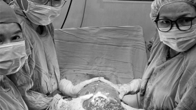 Cần Thơ: Phẫu thuật lấy thai và cắt khối u xơ tử cung nặng 6,2kg