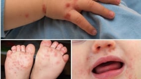 Vắc xin EV71 – Hy vọng mới trong phòng, chống bệnh tay chân miệng tại Việt Nam