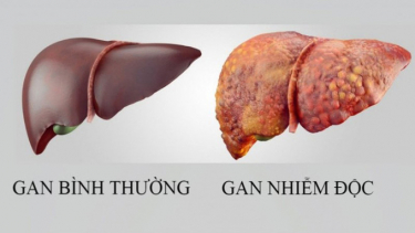 Cách phòng bệnh nhiễm độc gan