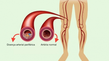 Triệu chứng, nguyên nhân và cách điều trị bệnh động mạch chủ ngoại biên