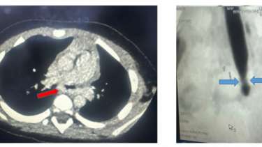 Điều trị thành công cho bệnh nhi bị vòng mạch quấn chèn khí phế quản