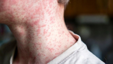 Cà Mau: Triển khai tiêm vét vắc xin sởi - rubella phòng, chống dịch sởi năm 2025