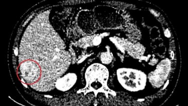 Phát hiện u gan khi khám sức khỏe định kỳ