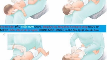 Hướng dẫn cách thực hiện thủ thuật Heimlich giúp cứu người bị hóc dị vật