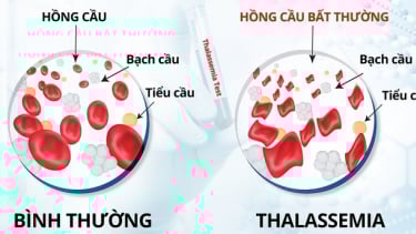 Hưởng ứng Ngày Thalassemia Thế giới 8/5: Chung tay vì sức khỏe cộng đồng