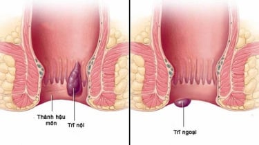 Hiểu đúng về bệnh trĩ để phòng ngừa hiệu quả