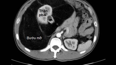 Phẫu thuật lấy trọn bướu mỡ khổng lồ nặng 8 kg trong bụng bệnh nhân