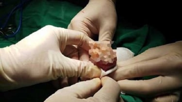 Những nguyên nhân gây ung thư dương vật