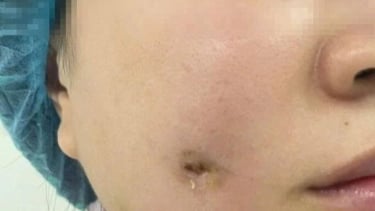 Cô gái bị nhiễm trùng sau khi đi làm má lúm đồng tiền